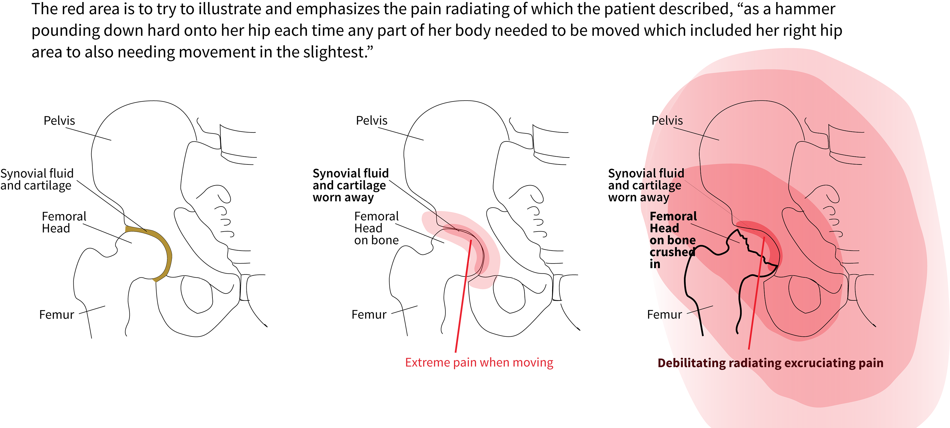 ball of femur deteriorating